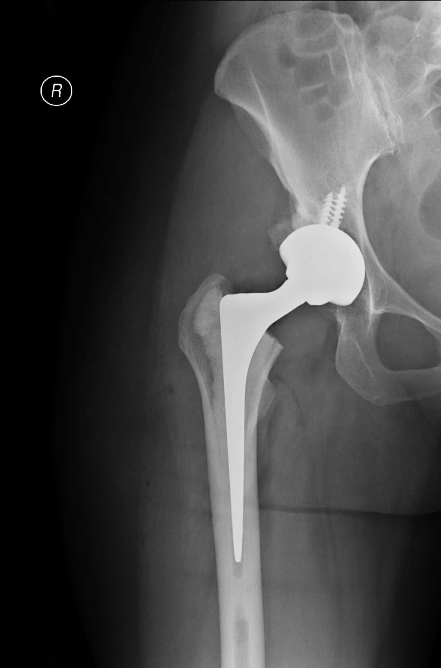 x-ray of hip replacement